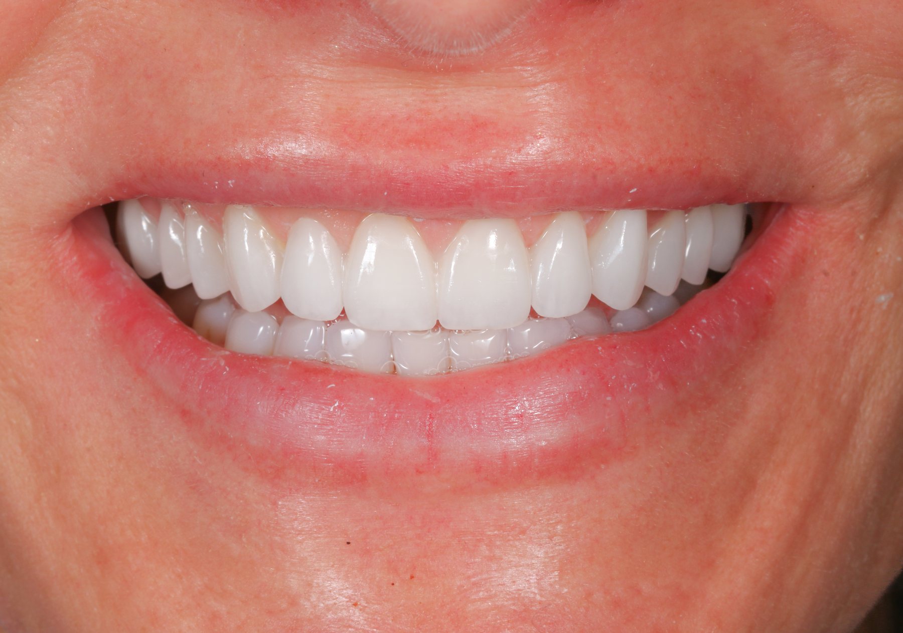 Delivered smile &middot; ceramic translucency