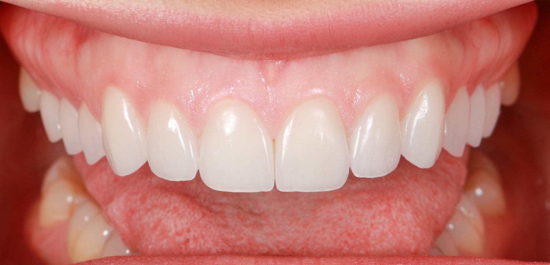 Delivered smile &middot; veneer aesthetics