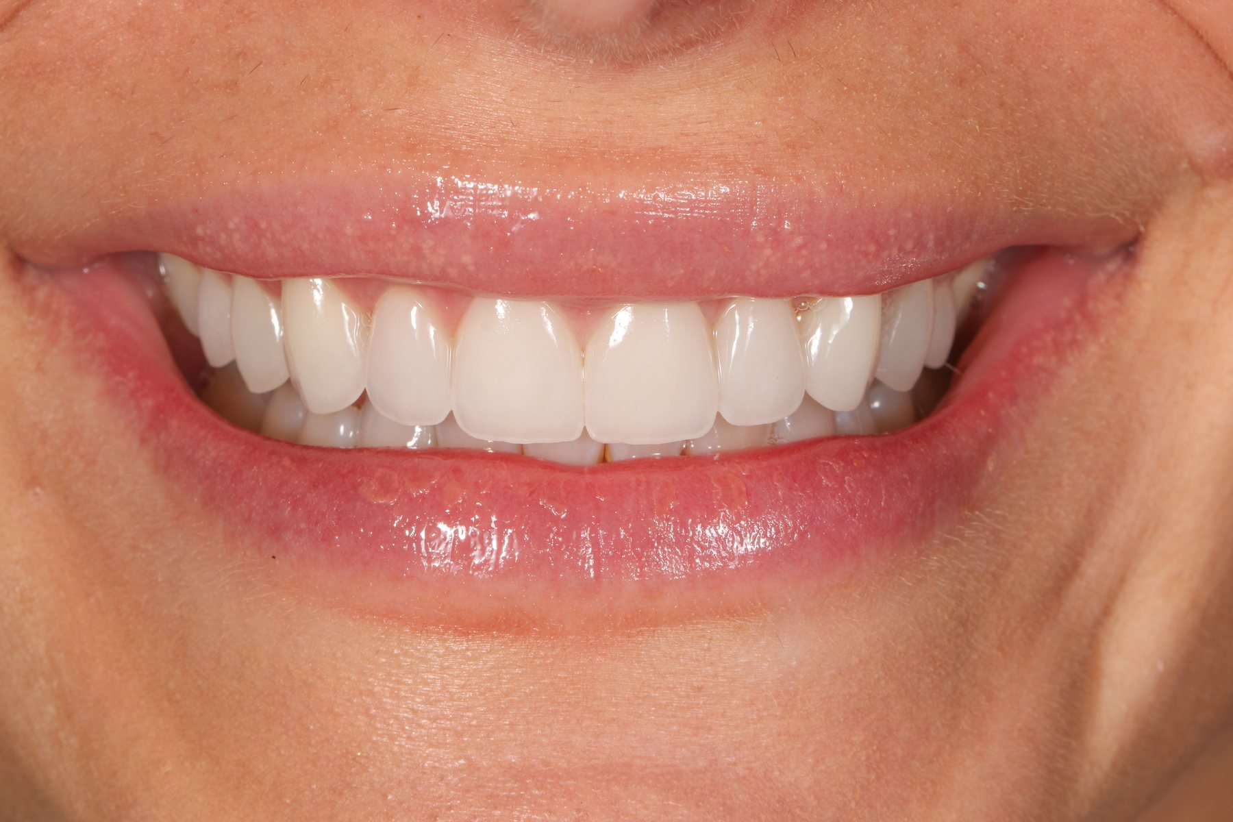 Delivered smile &middot; natural form