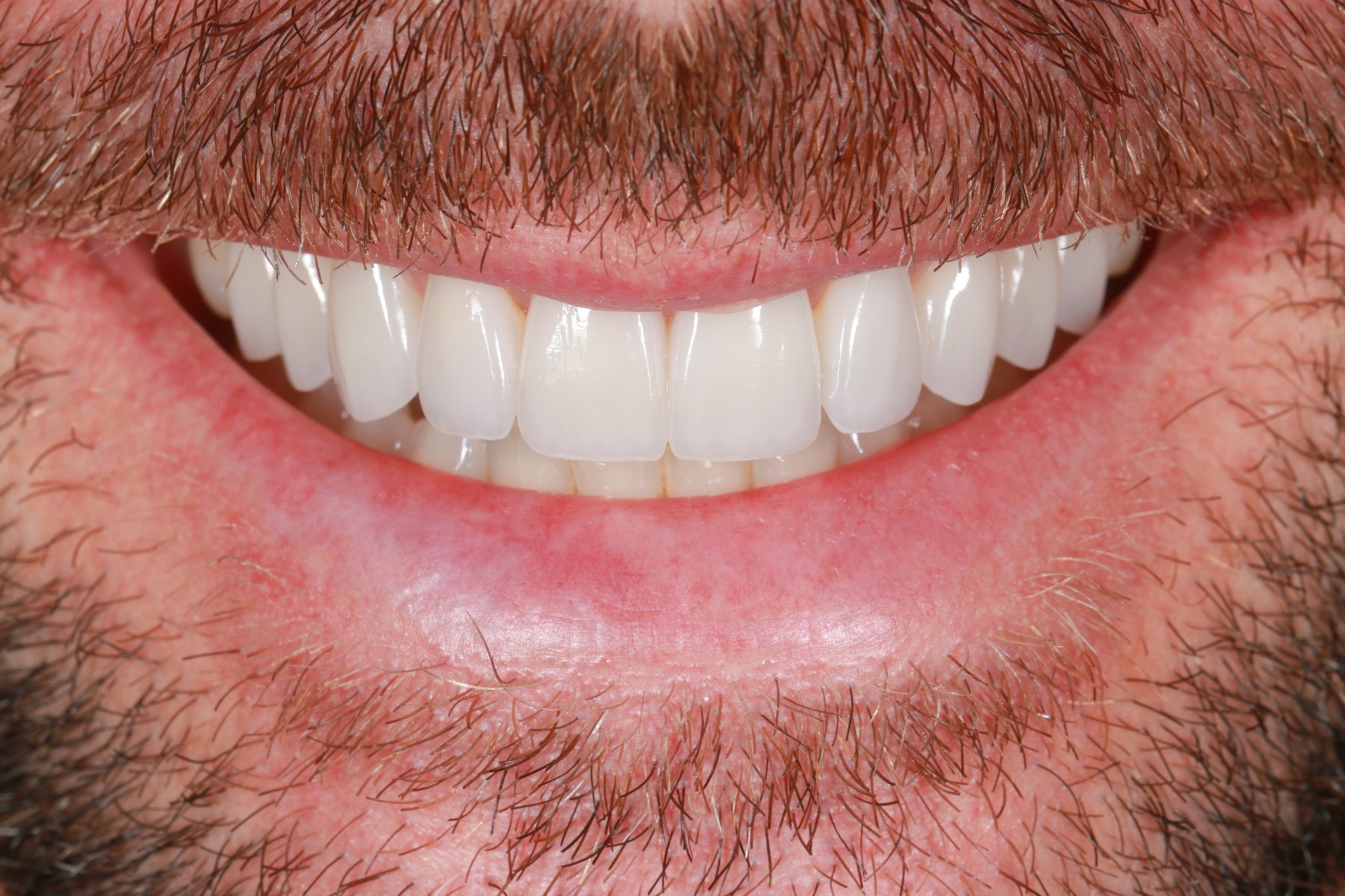 Delivered smile &middot; veneer aesthetics