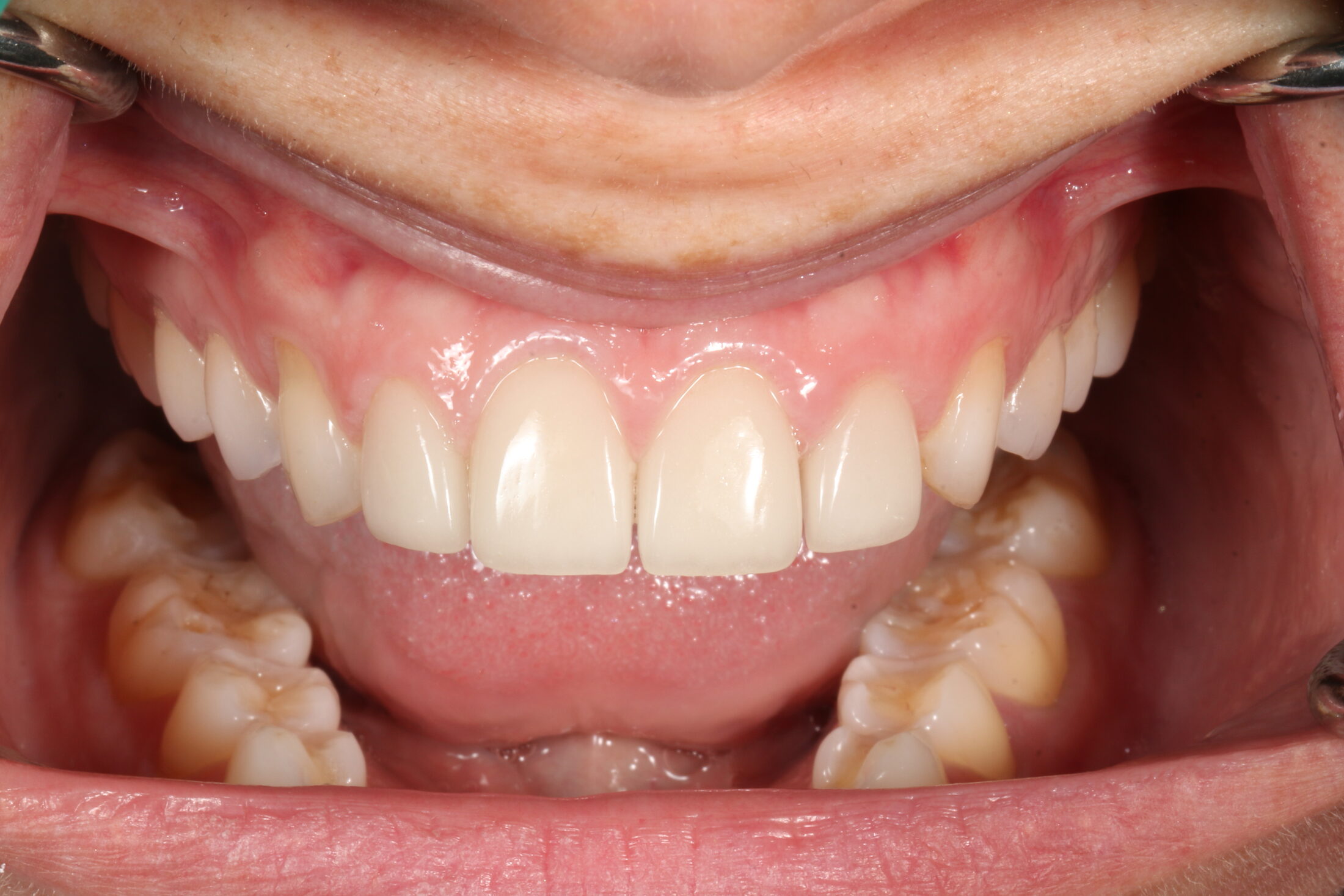 Structurally compromised teeth before full-coverage crowns