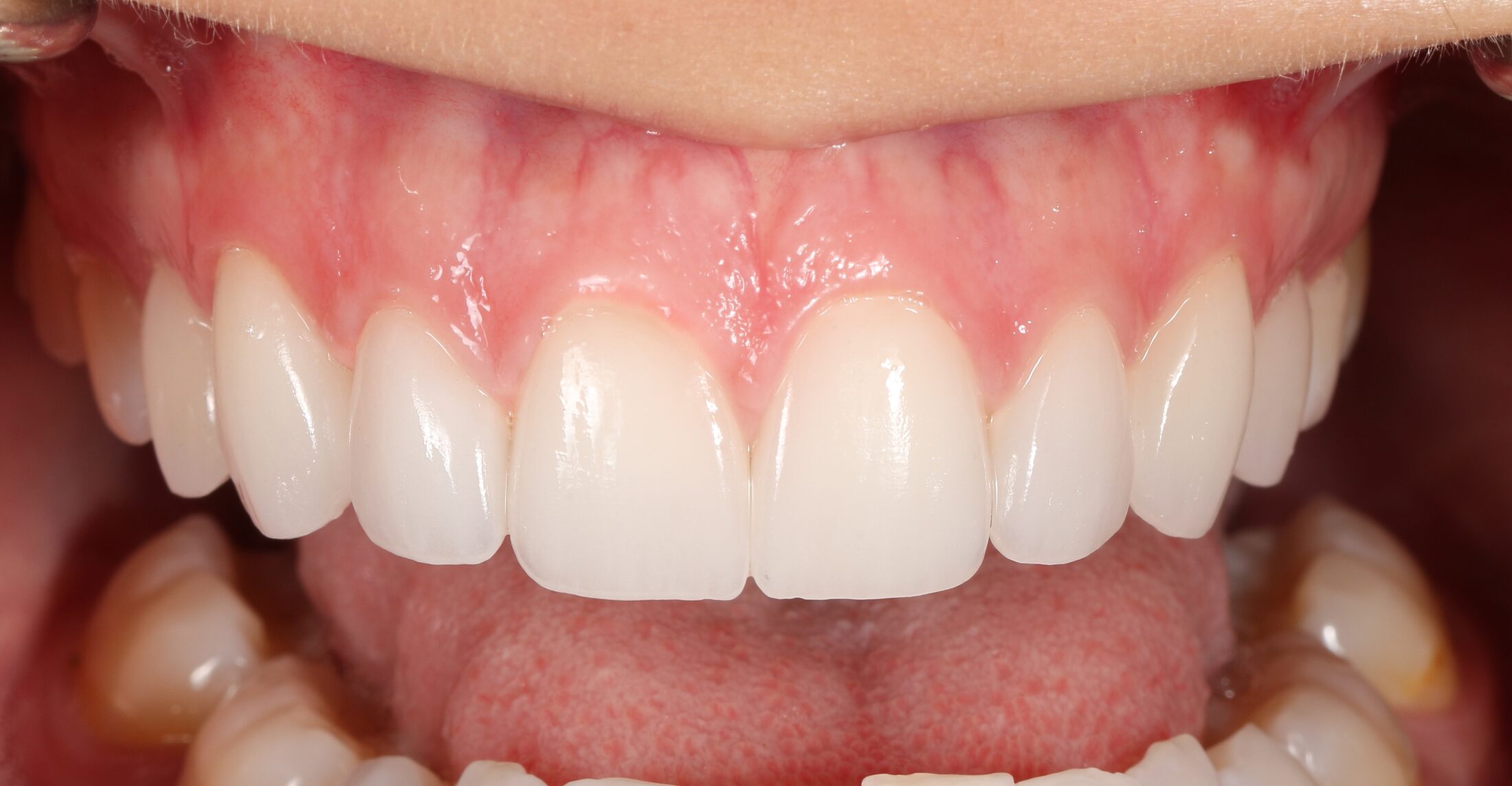 Anterior veneers — before and after