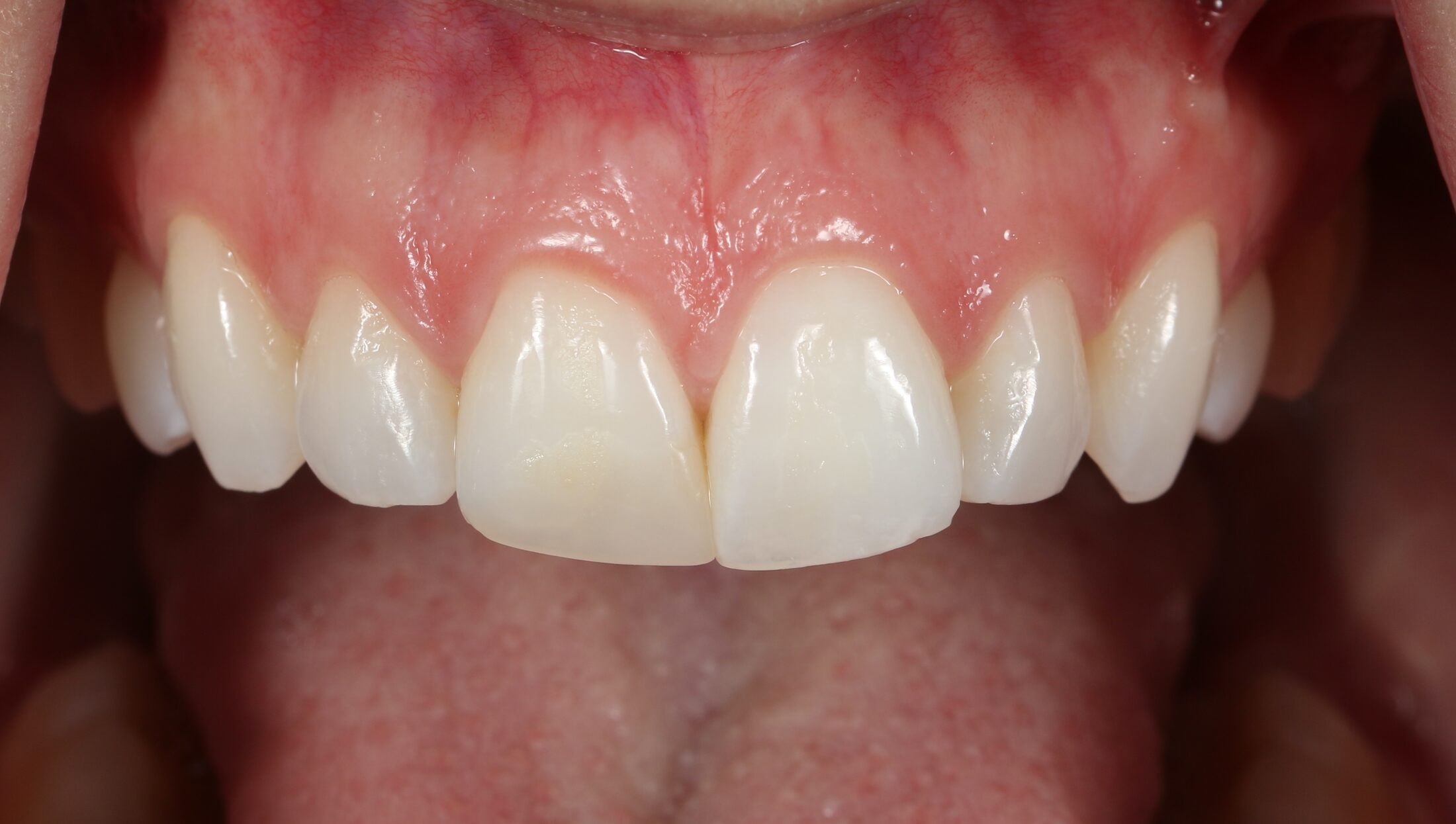 Smile before veneers &mdash; refining tooth shape and proportion