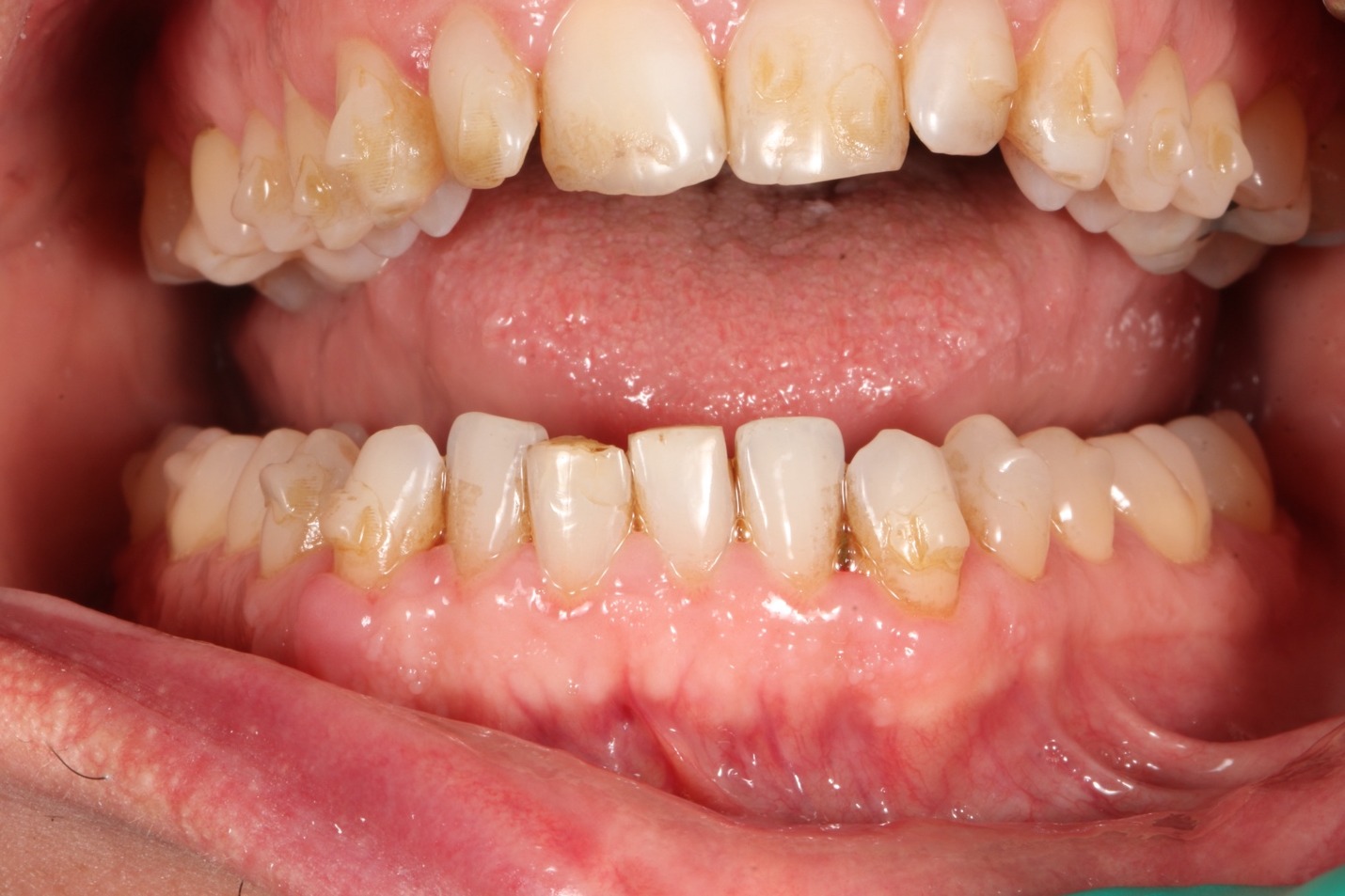 Smile before veneers &mdash; correcting alignment without braces